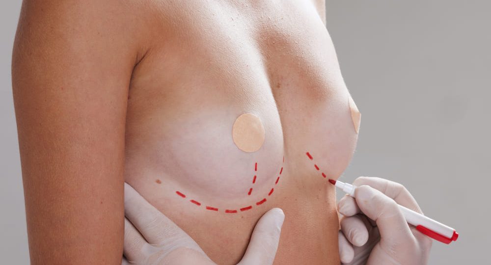 Reafirmación de senos tras el embarazo: alternativas sin marcas