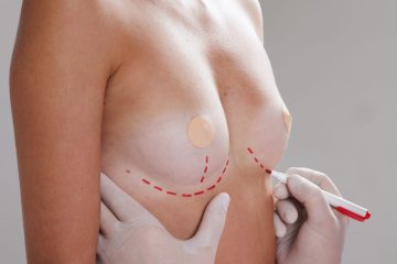 Reafirmación de senos tras el embarazo: alternativas sin marcas