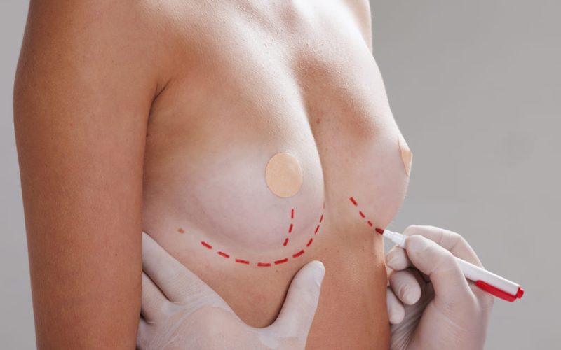 Reafirmación de senos tras el embarazo: alternativas sin marcas